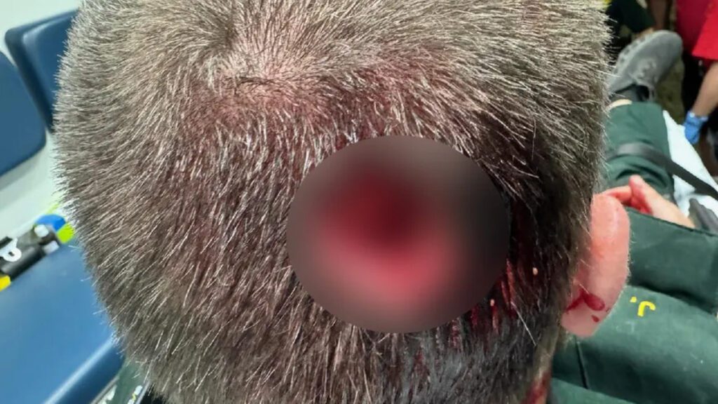 Drugged Man Bites "piece" Off Police Officer's Head At Florida